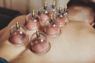 The Potential of Cupping Therapy: Enhancing Athletic Performance and Recovery